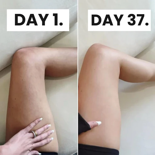 Novara™ Cellulite relief in 30 days