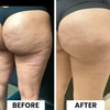 Novara™ Cellulite relief in 30 days
